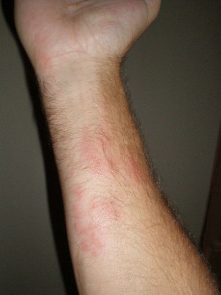 cannonball-sting-10-07 174 Here is what an untreated sting would look like. This was from a cannonball jelly, which gives a very mild sting. Photo sent to me by Smedrock.