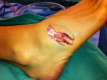 shark-bite-before-repair